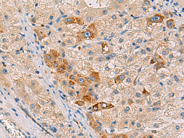 Immunohistochemistry of paraffin-embedded Human liver cancer tissue  using RMDN2 Polyclonal Antibody at dilution of 1:50(×200)