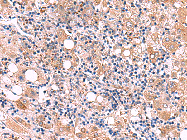 Immunohistochemistry of paraffin-embedded Human liver cancer tissue  using LIPA Polyclonal Antibody at dilution of 1:50(×200)