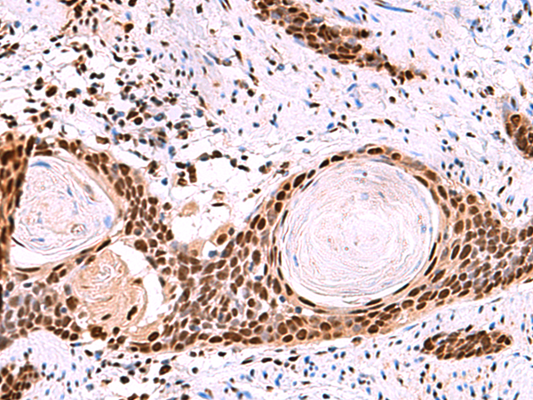 Immunohistochemistry of paraffin-embedded Human esophagus cancer tissue  using SF3B3 Polyclonal Antibody at dilution of 1:50(×200)