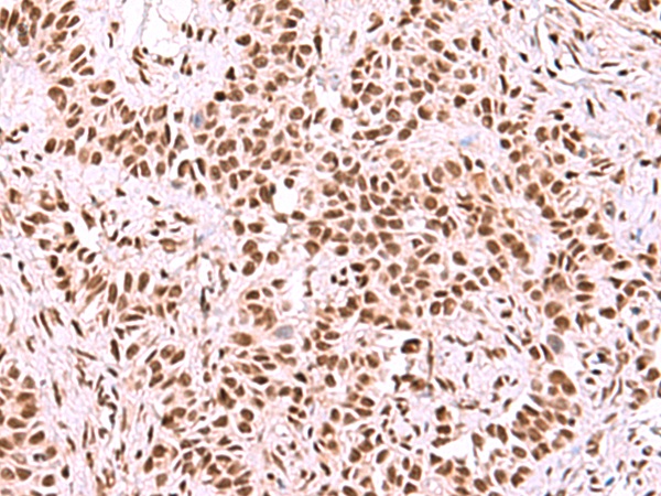 Immunohistochemistry of paraffin-embedded Human ovarian cancer tissue  using SF3B3 Polyclonal Antibody at dilution of 1:50(×200)