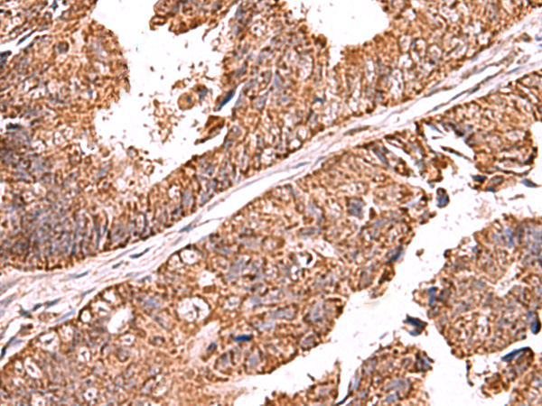 Immunohistochemistry of paraffin-embedded Human colorectal cancer tissue  using UBAC1 Polyclonal Antibody at dilution of 1:60(×200)