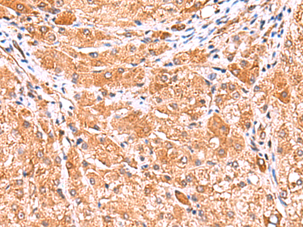 Immunohistochemistry of paraffin-embedded Human liver cancer tissue  using PHKG2 Polyclonal Antibody at dilution of 1:60(×200)