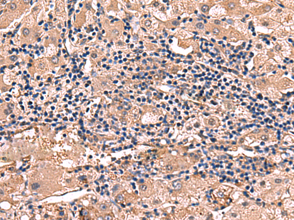 Immunohistochemistry of paraffin-embedded Human liver cancer tissue  using RHAG Polyclonal Antibody at dilution of 1:110(×200)