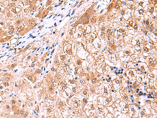 Immunohistochemistry of paraffin-embedded Human liver cancer tissue  using FDFT1 Polyclonal Antibody at dilution of 1:75(×200)