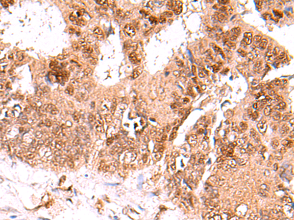 Immunohistochemistry of paraffin-embedded Human colorectal cancer tissue  using FDPS Polyclonal Antibody at dilution of 1:60(×200)