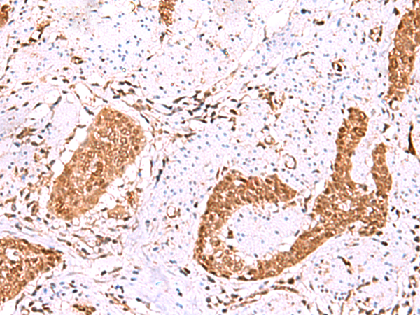 Immunohistochemistry of paraffin-embedded Human esophagus cancer tissue  using FDPS Polyclonal Antibody at dilution of 1:60(×200)