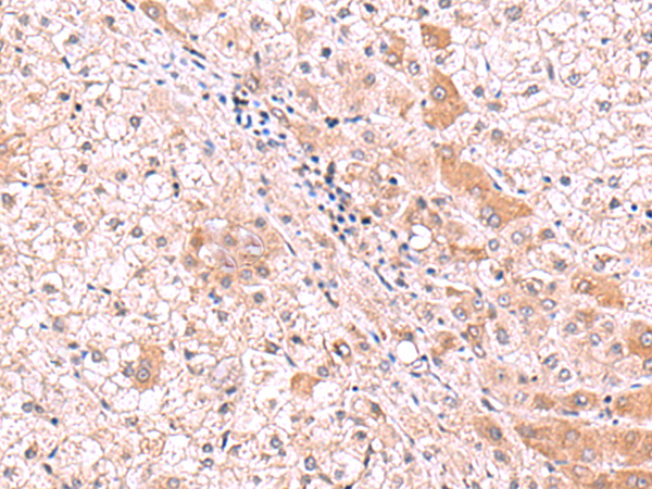 Immunohistochemistry of paraffin-embedded Human liver cancer tissue  using RIC8A Polyclonal Antibody at dilution of 1:80(×200)