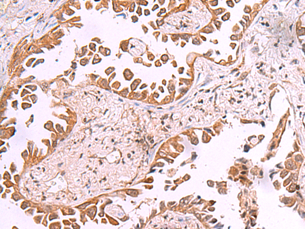 Immunohistochemistry of paraffin-embedded Human lung cancer tissue  using AK9 Polyclonal Antibody at dilution of 1:85(×200)