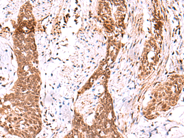 Immunohistochemistry of paraffin-embedded Human esophagus cancer tissue  using AK9 Polyclonal Antibody at dilution of 1:85(×200)