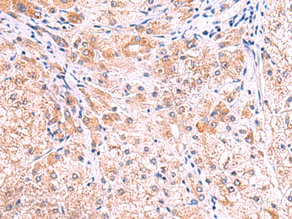 Immunohistochemistry of paraffin-embedded Human liver cancer tissue  using SMPD2 Polyclonal Antibody at dilution of 1:70(×200)