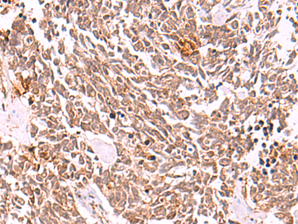 Immunohistochemistry of paraffin-embedded Human lung cancer tissue  using COPS3 Polyclonal Antibody at dilution of 1:50(×200)
