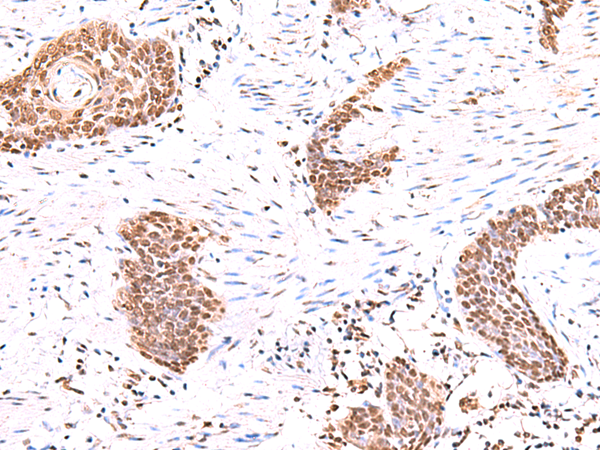 Immunohistochemistry of paraffin-embedded Human esophagus cancer tissue  using ACTL6B Polyclonal Antibody at dilution of 1:55(×200)