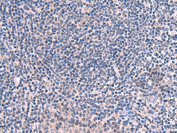 Immunohistochemistry of paraffin-embedded Human tonsil tissue  using SCCPDH Polyclonal Antibody at dilution of 1:50(×200)
