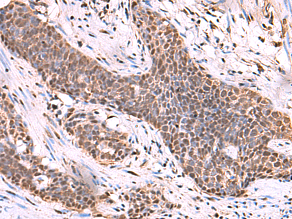 Immunohistochemistry of paraffin-embedded Human esophagus cancer tissue  using SCCPDH Polyclonal Antibody at dilution of 1:50(×200)