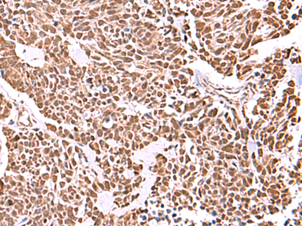 Immunohistochemistry of paraffin-embedded Human lung cancer tissue  using RCOR3 Polyclonal Antibody at dilution of 1:55(×200)