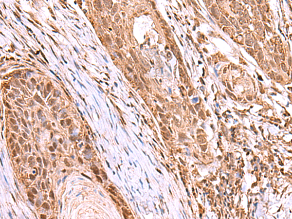 Immunohistochemistry of paraffin-embedded Human esophagus cancer tissue  using RCOR3 Polyclonal Antibody at dilution of 1:55(×200)