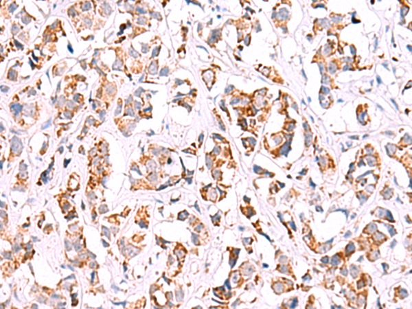Immunohistochemistry of paraffin-embedded Human breast cancer tissue  using SIGLEC6 Polyclonal Antibody at dilution of 1:50(×200)