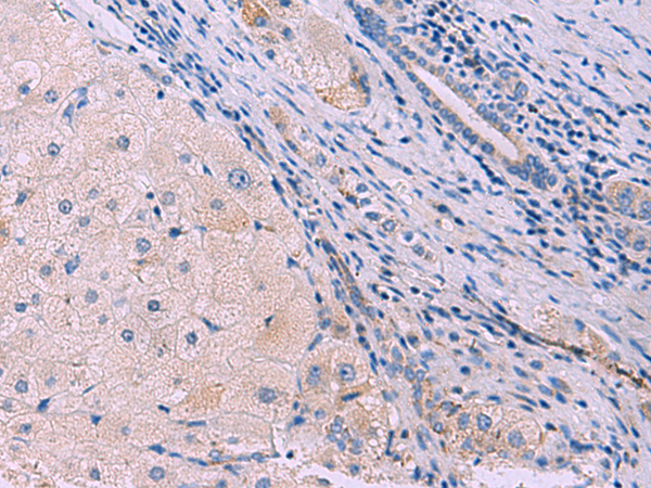 Immunohistochemistry of paraffin-embedded Human liver cancer tissue  using SIGLEC6 Polyclonal Antibody at dilution of 1:50(×200)