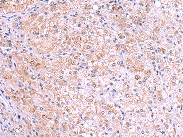 Immunohistochemistry of paraffin-embedded Human liver cancer tissue  using KIR3DL1 Polyclonal Antibody at dilution of 1:105(×200)