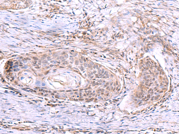 Immunohistochemistry of paraffin-embedded Human esophagus cancer tissue  using AKAP17A Polyclonal Antibody at dilution of 1:80(×200)