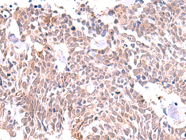 Immunohistochemistry of paraffin-embedded Human lung cancer tissue  using INPP5K Polyclonal Antibody at dilution of 1:85(×200)