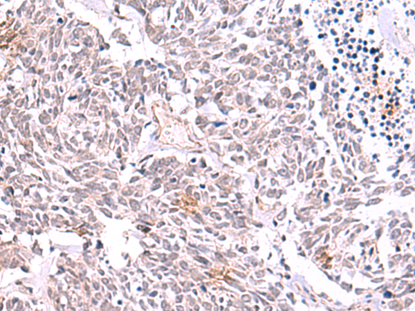 Immunohistochemistry of paraffin-embedded Human lung cancer tissue  using TRMT12 Polyclonal Antibody at dilution of 1:85(×200)