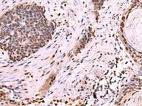 Immunohistochemistry of paraffin-embedded Human esophagus cancer tissue  using NASP Polyclonal Antibody at dilution of 1:60(×200)