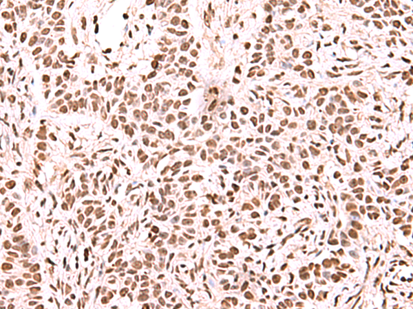 Immunohistochemistry of paraffin-embedded Human ovarian cancer tissue  using NASP Polyclonal Antibody at dilution of 1:60(×200)