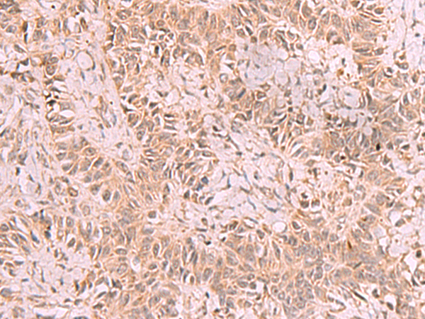Immunohistochemistry of paraffin-embedded Human ovarian cancer tissue  using RRP8 Polyclonal Antibody at dilution of 1:70(×200)