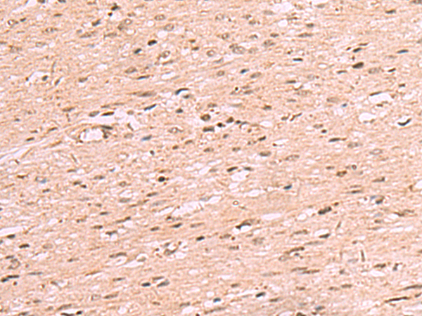 Immunohistochemistry of paraffin-embedded Human colorectal cancer tissue  using RRP8 Polyclonal Antibody at dilution of 1:70(×200)