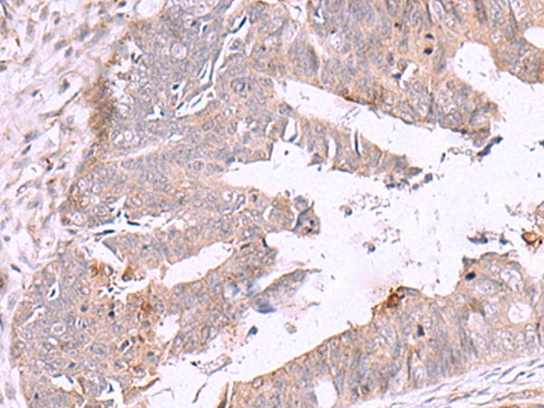 Immunohistochemistry of paraffin-embedded Human colorectal cancer tissue  using ZSWIM1 Polyclonal Antibody at dilution of 1:55(×200)