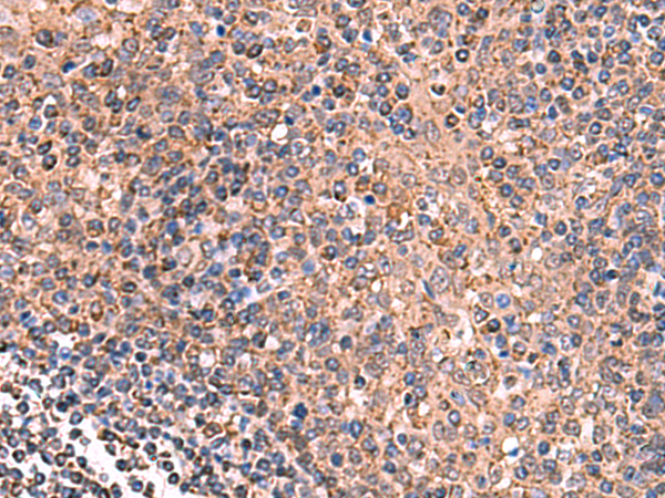 Immunohistochemistry of paraffin-embedded Human tonsil tissue  using GALK2 Polyclonal Antibody at dilution of 1:160(×200)