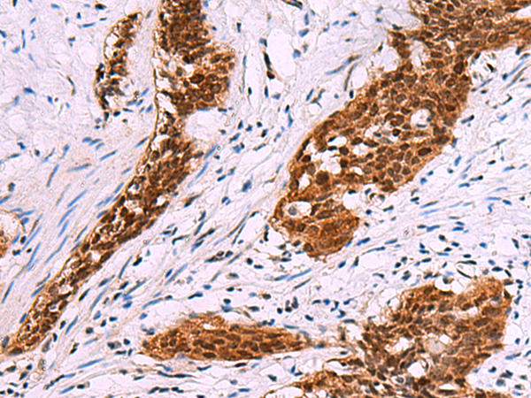 Immunohistochemistry of paraffin-embedded Human esophagus cancer tissue  using FKBP4 Polyclonal Antibody at dilution of 1:50(×200)