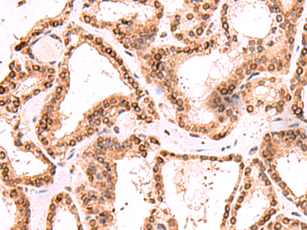 Immunohistochemistry of paraffin-embedded Human thyroid cancer tissue  using TOR1AIP1 Polyclonal Antibody at dilution of 1:60(×200)