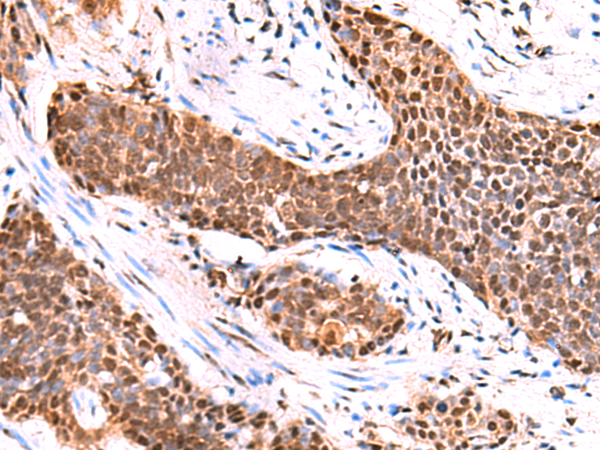 Immunohistochemistry of paraffin-embedded Human esophagus cancer tissue  using TSEN2 Polyclonal Antibody at dilution of 1:80(×200)