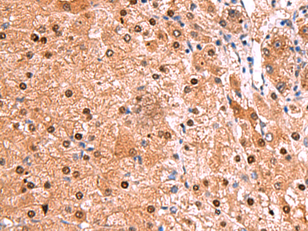 Immunohistochemistry of paraffin-embedded Human liver cancer tissue  using TSEN2 Polyclonal Antibody at dilution of 1:80(×200)