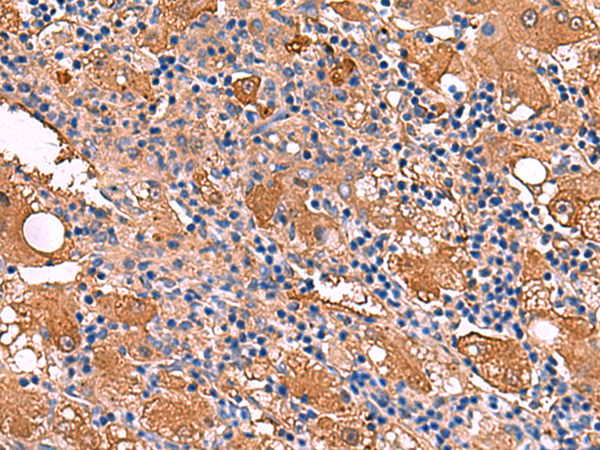Immunohistochemistry of paraffin-embedded Human liver cancer tissue  using FUCA2 Polyclonal Antibody at dilution of 1:80(×200)