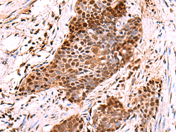 Immunohistochemistry of paraffin-embedded Human esophagus cancer tissue  using POLD2 Polyclonal Antibody at dilution of 1:60(×200)