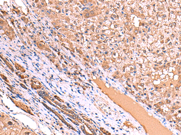 Immunohistochemistry of paraffin-embedded Human liver cancer tissue  using TTC38 Polyclonal Antibody at dilution of 1:85(×200)