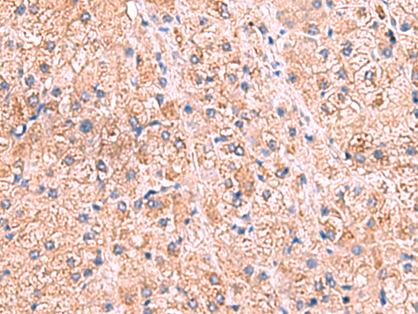 Immunohistochemistry of paraffin-embedded Human liver cancer tissue  using ZNF256 Polyclonal Antibody at dilution of 1:70(×200)