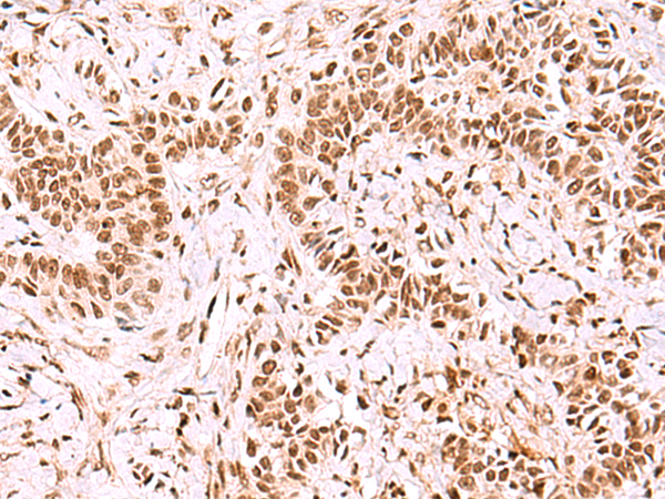 Immunohistochemistry of paraffin-embedded Human ovarian cancer tissue  using GPKOW Polyclonal Antibody at dilution of 1:100(×200)