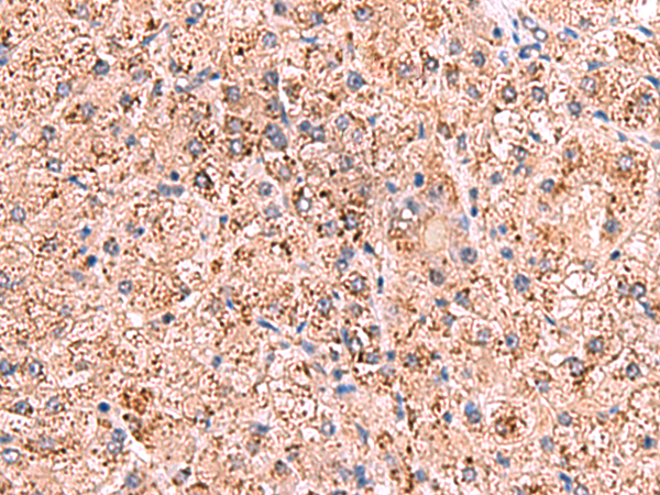 Immunohistochemistry of paraffin-embedded Human liver cancer tissue  using OSBPL2 Polyclonal Antibody at dilution of 1:65(×200)