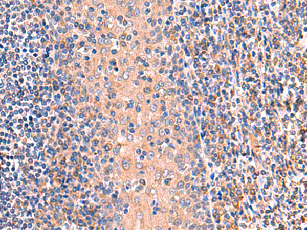 Immunohistochemistry of paraffin-embedded Human tonsil tissue  using OSBPL2 Polyclonal Antibody at dilution of 1:65(×200)