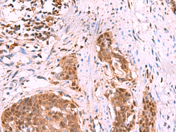 Immunohistochemistry of paraffin-embedded Human esophagus cancer tissue  using KATNAL1 Polyclonal Antibody at dilution of 1:80(×200)