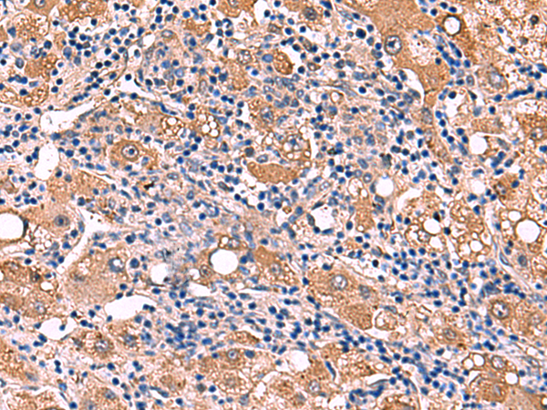 Immunohistochemistry of paraffin-embedded Human liver cancer tissue  using FDXR Polyclonal Antibody at dilution of 1:110(×200)