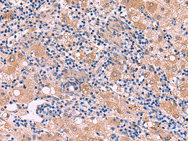 Immunohistochemistry of paraffin-embedded Human liver cancer tissue  using PEPD Polyclonal Antibody at dilution of 1:85(×200)