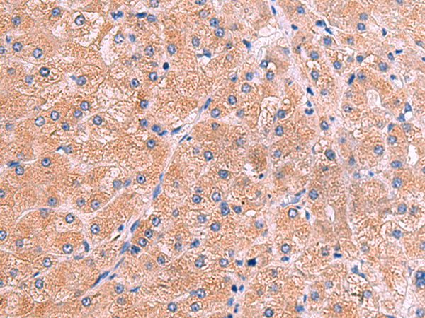 Immunohistochemistry of paraffin-embedded Human liver cancer tissue  using ZAP70 Polyclonal Antibody at dilution of 1:60(×200)