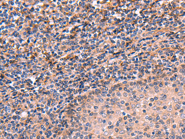 Immunohistochemistry of paraffin-embedded Human tonsil tissue  using ARIH2 Polyclonal Antibody at dilution of 1:70(×200)