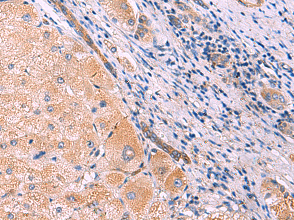 Immunohistochemistry of paraffin-embedded Human liver cancer tissue  using MYOT Polyclonal Antibody at dilution of 1:70(×200)