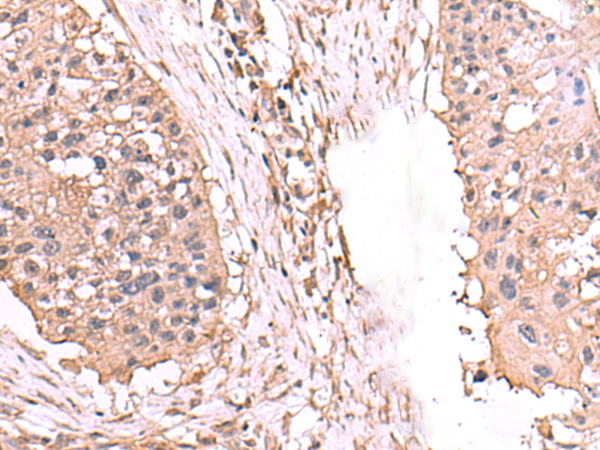 Immunohistochemistry of paraffin-embedded Human esophagus cancer tissue  using AHCYL1 Polyclonal Antibody at dilution of 1:65(×200)